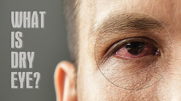 WHAT IS DRY EYE?